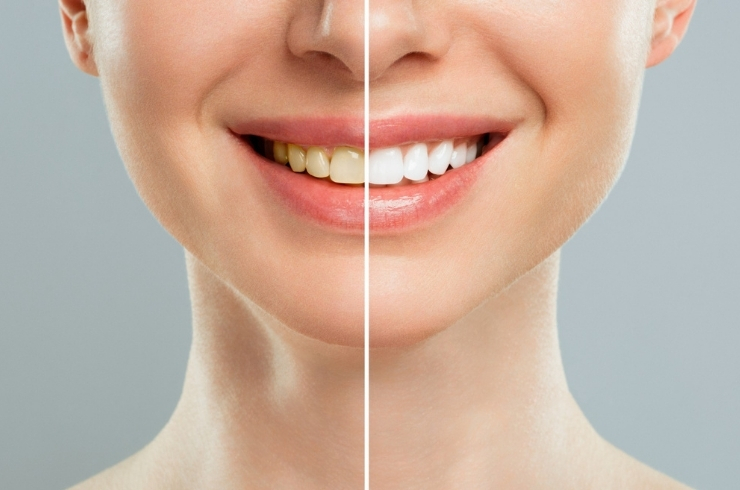 Teeth Whitening