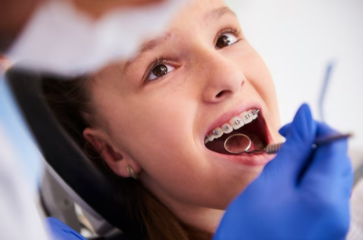 Orthodontic Braces