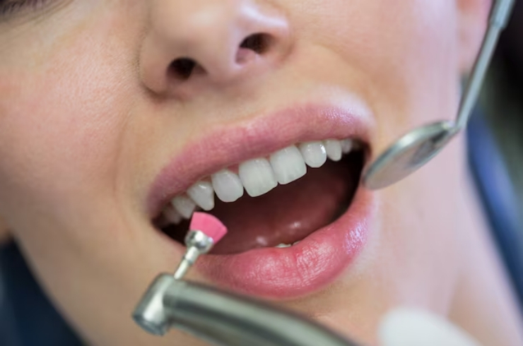Cosmetic Bonding