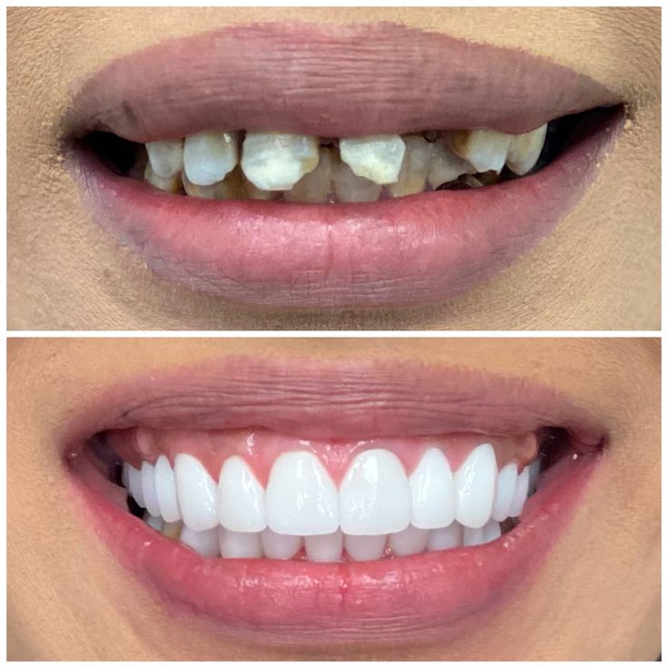 Dental implant structure and placement guide