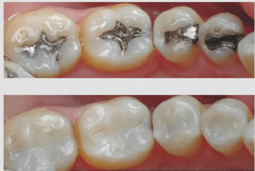 Tooth cavity before and after composite filling Kondapur