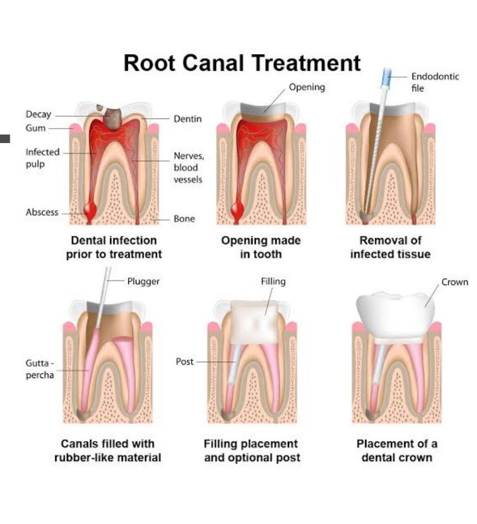 Root Canal Treatment — what happens step by step