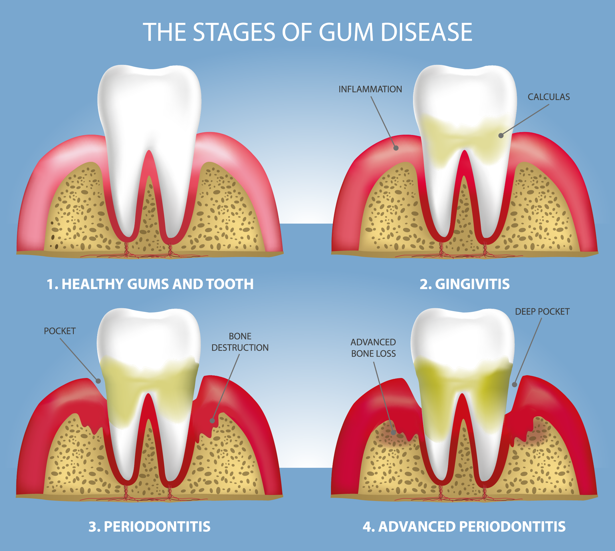 Gum disease treatment at SJ Apex Dental Kondapur Hyderabad