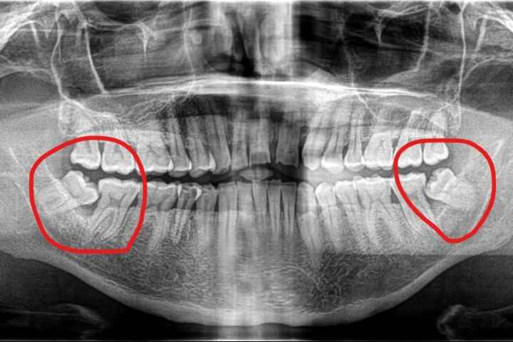 Impacted wisdom tooth X-ray — wisdom tooth removal Kondapur