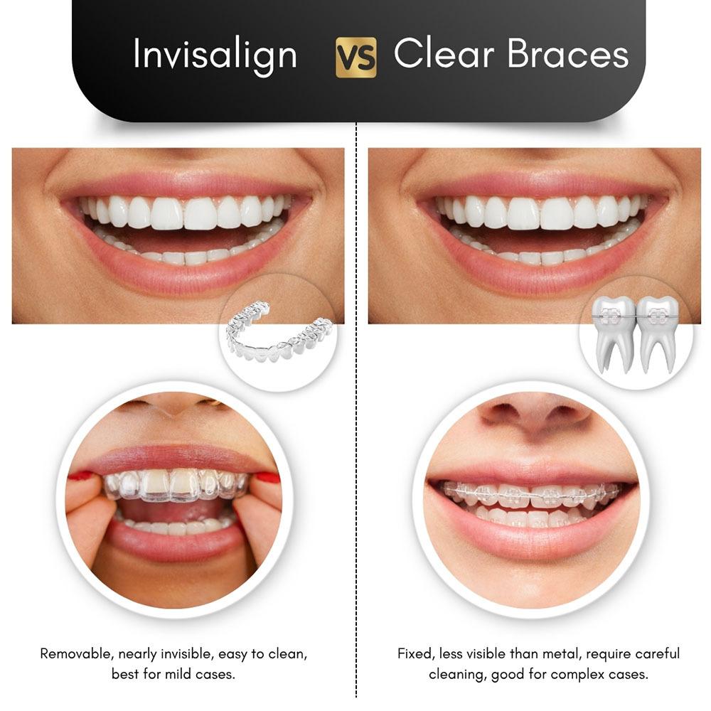 Braces vs Invisalign clear aligners comparison