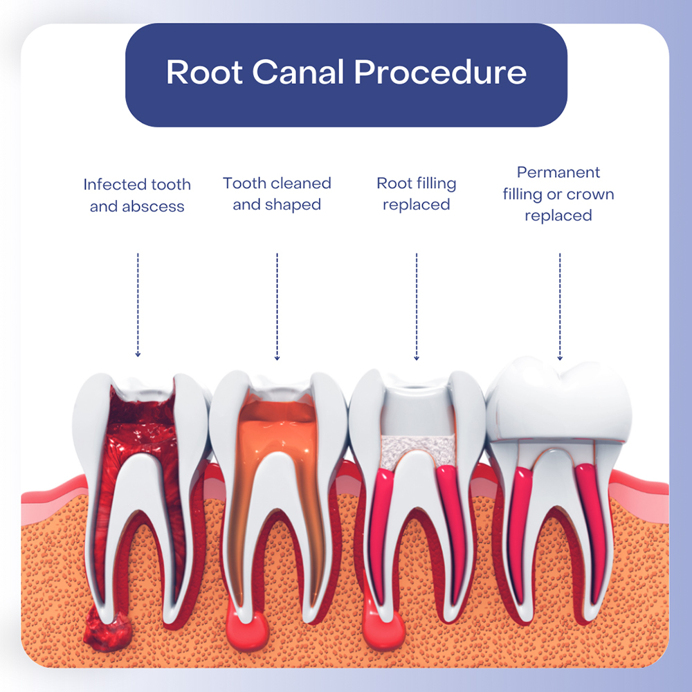 Root canal procedure close-up at SJ Apex Dental