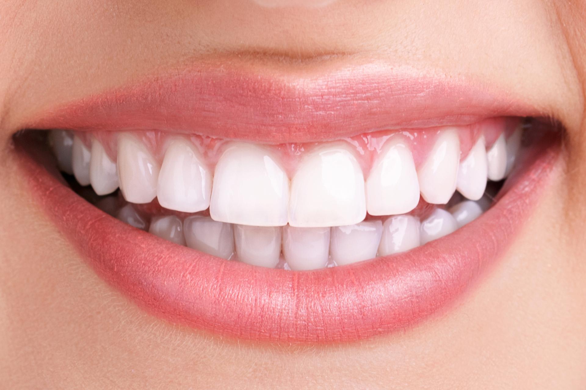Teeth whitening before and after at SJ Apex Dental Kondapur