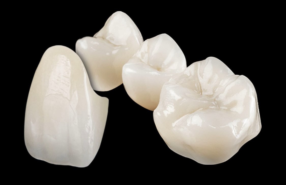 Zirconia dental crown restoration at SJ Apex Dental Kondapur